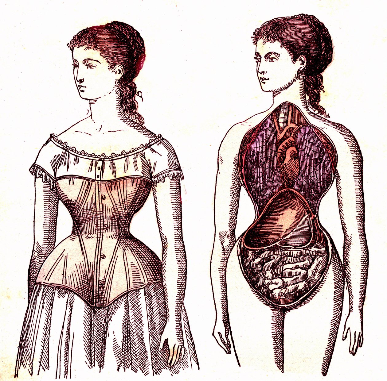 Compression du corset - La Vie Normale et Santé par J. Rengade. Dessin de A. Demarle 1881 - Alphonse Demarle
