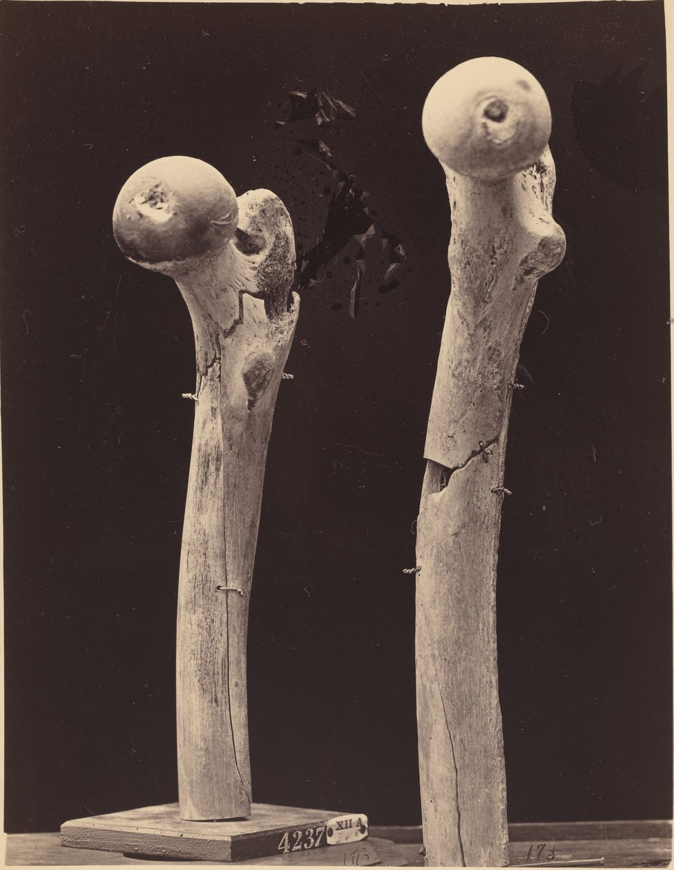 Spécimens de fractures par balle du fémur - American 19th Century