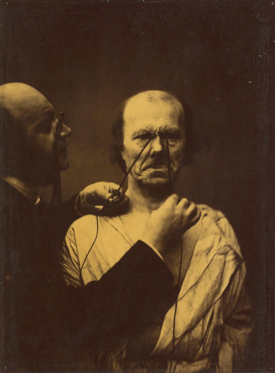 Agression, méchanceté, 1854-1856, imprimé 1862 - Duchenne de Boulogne