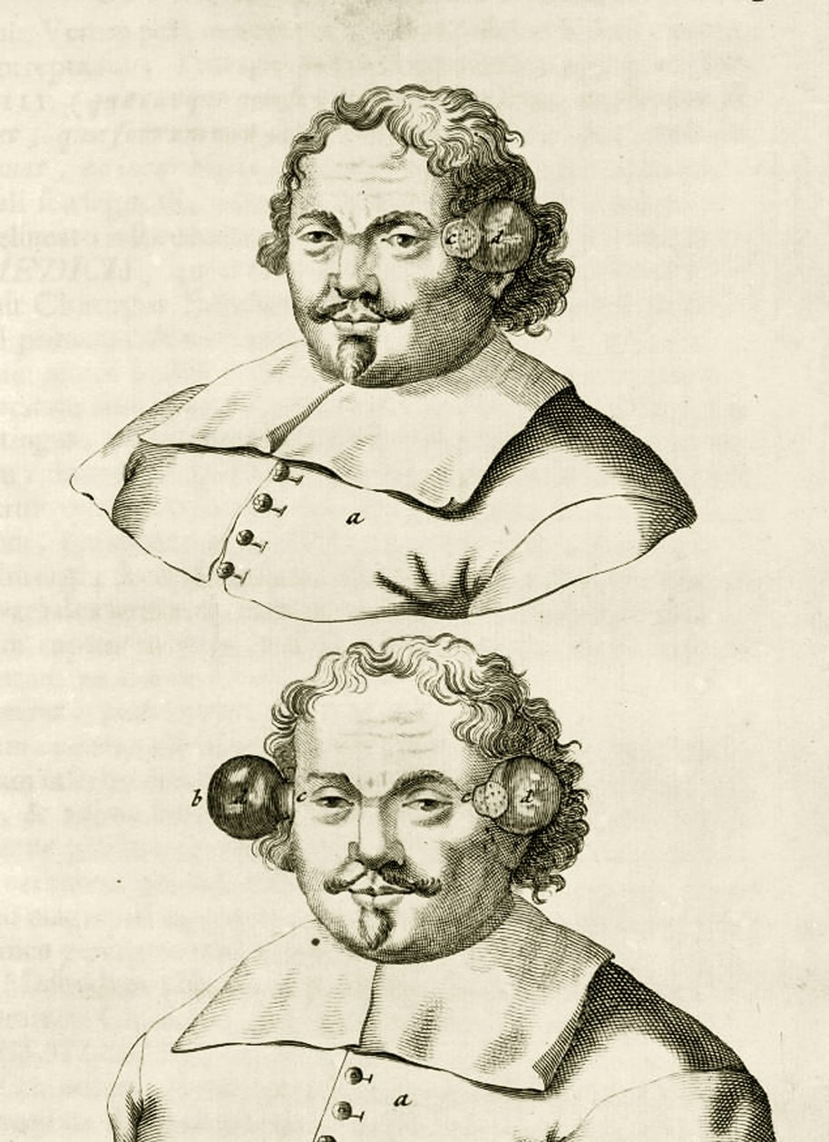 Un exemple de ventouses, de Exercitationes Practicae circa Medendi Methodum par Frederik Dekkers, 1694 - Dutch School