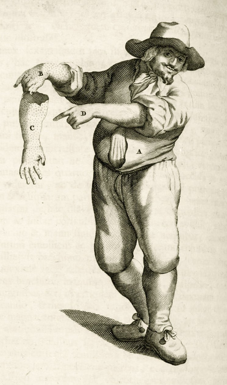 Retrait de la peau morte avec des pustules, de Exercitationes Practicae circa Medendi Methodum par Frederik Dekkers, 1694 - Dutch School