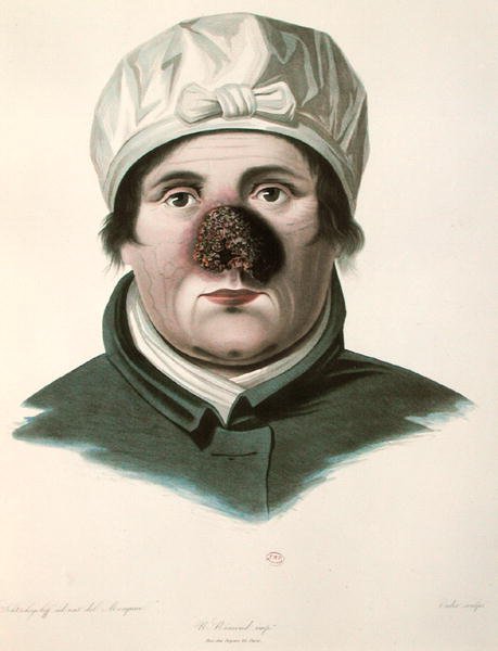Avant une opération de greffe de peau, de 