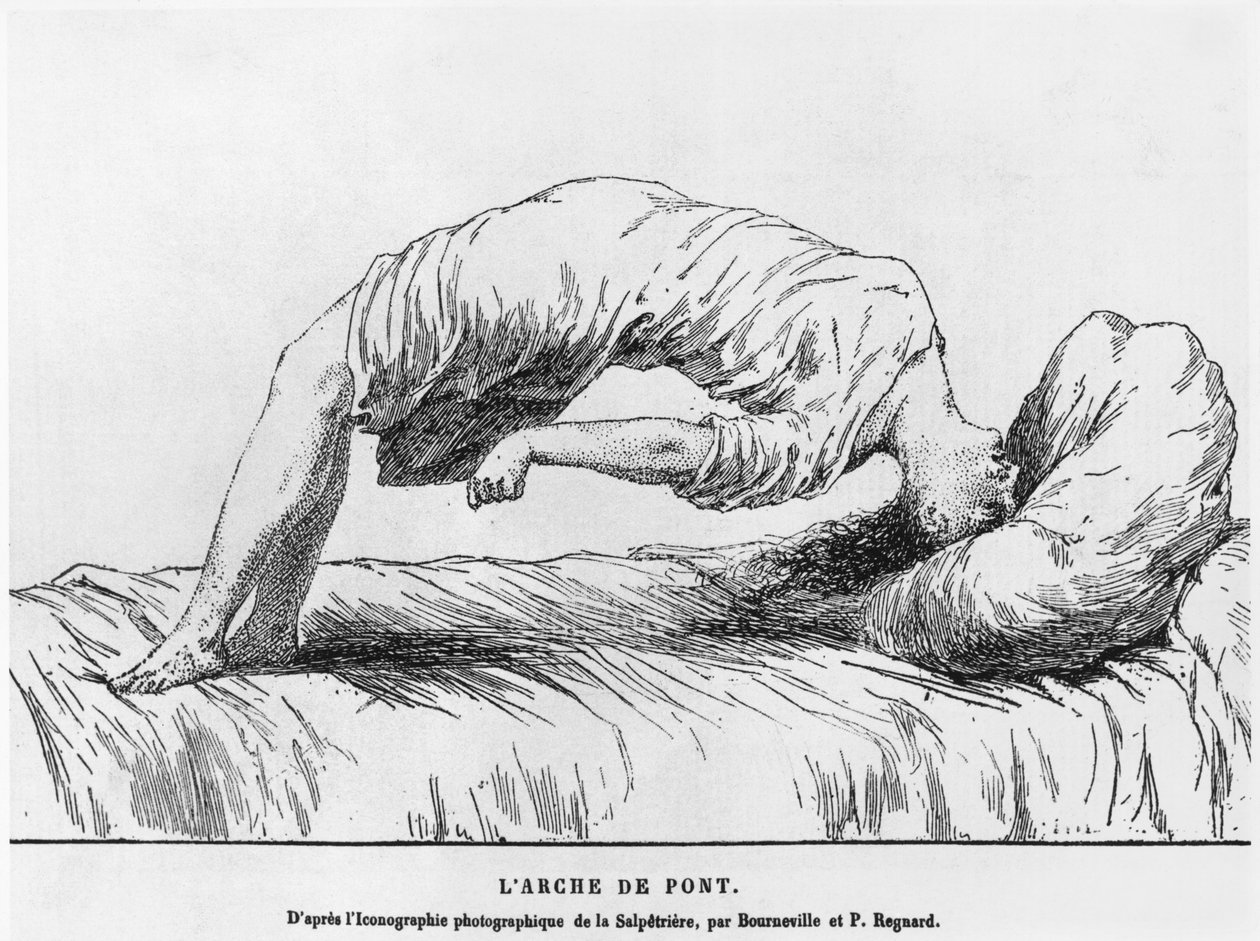 Hystérie et somnambulisme, de Les Maladies Épidémiques de l