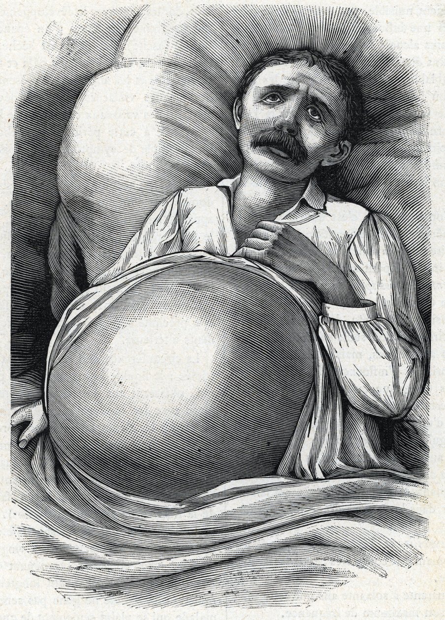Patient avec cirrhose hépatique avancée (gravure) 1888 - French School