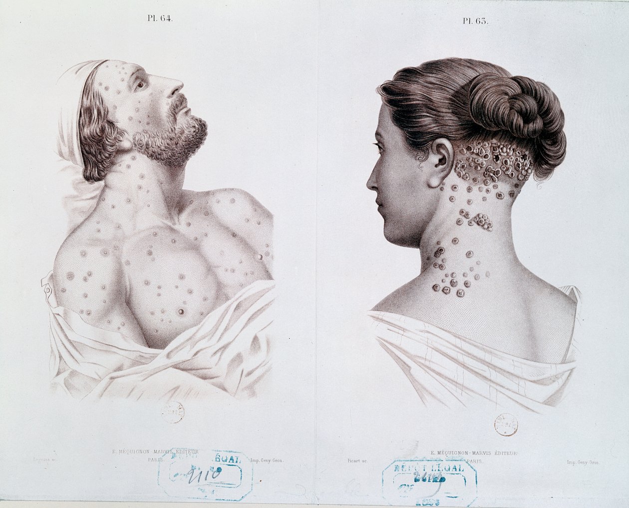 Symptômes de la syphilis chez les hommes et les femmes, d