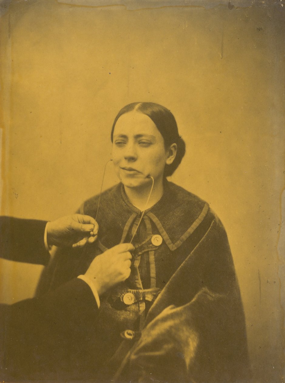 Dégoût méprisant (à gauche) ; Rire méprisant (à droite),1854-1856, imprimé en 1862 (photo) - Guillaume Benjamin Armand Duchenne de Boulogne