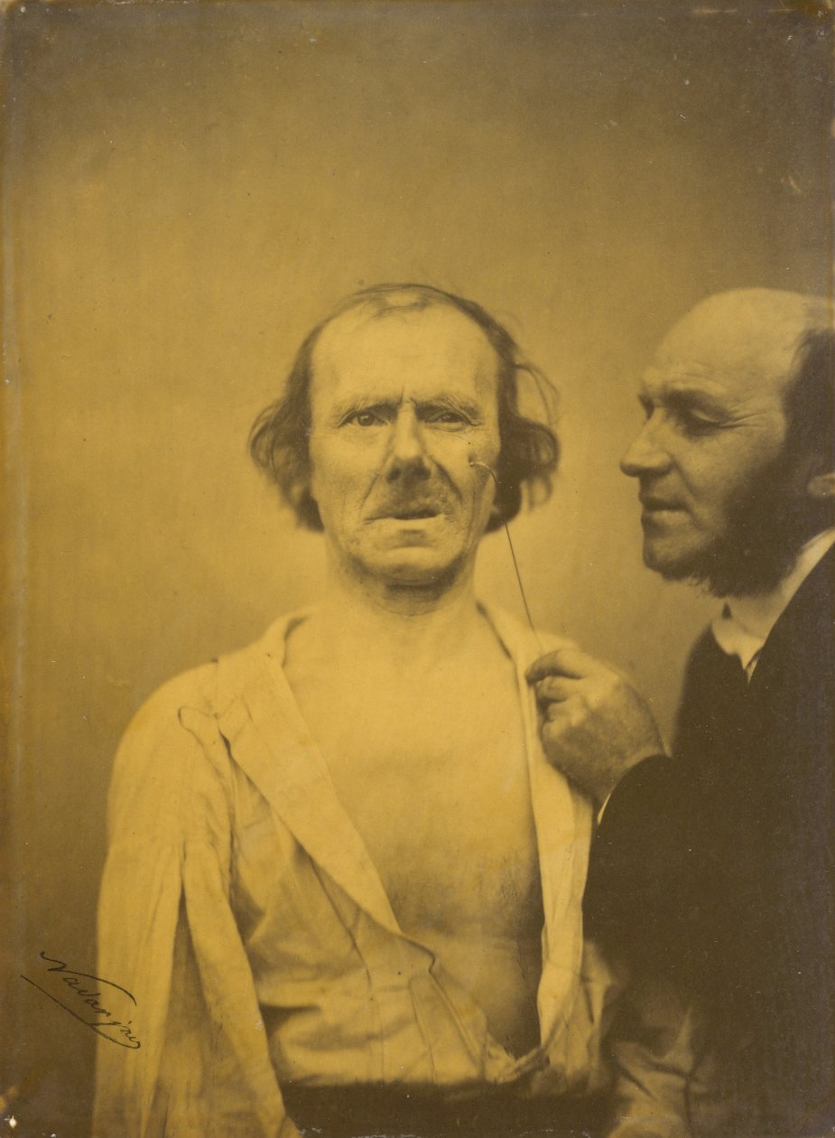 Pleurs, larmes de pitié (à gauche) ; Visage détendu (à droite),1854-1856, imprimé en 1862 (photo) - Guillaume Benjamin Armand Duchenne de Boulogne