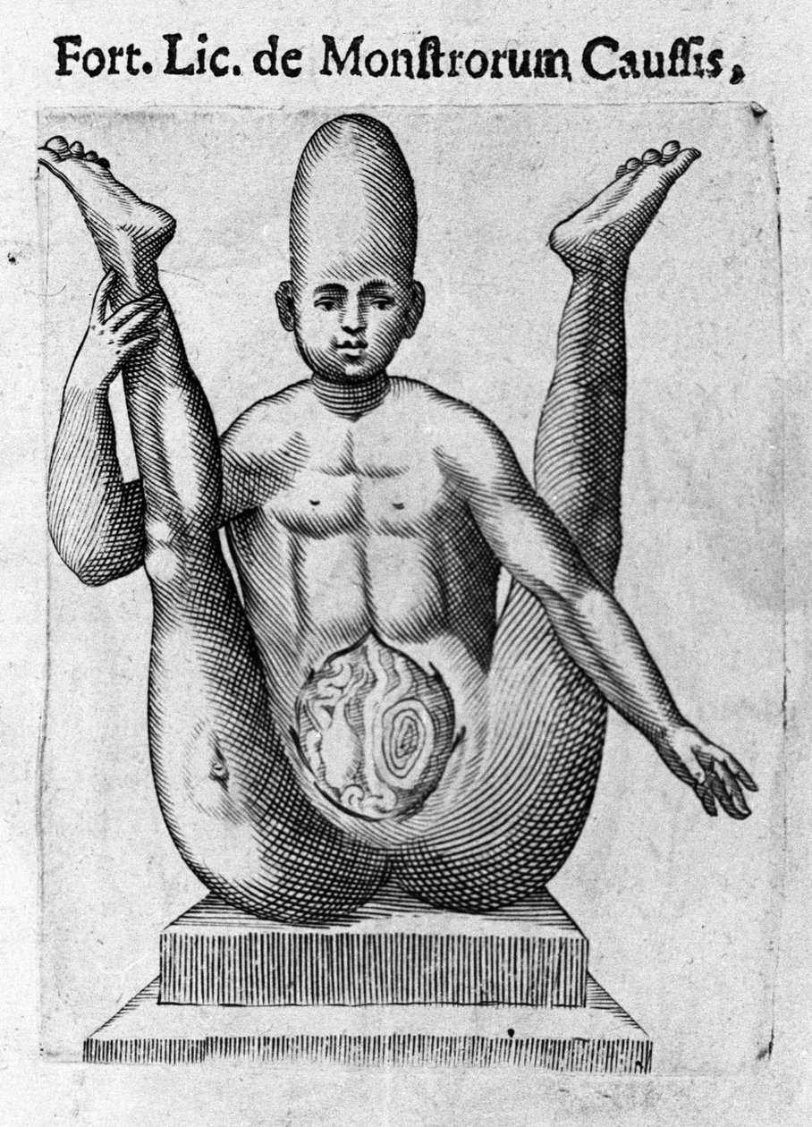 Monstre humain : une créature avec un crâne énorme, avec des entrailles apparentes. Gravure de « De monstrorum natura, causis et differentiis » par Fortunio Liceti, 1646 - Italian School