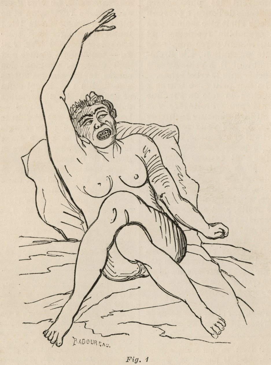 Épilepsie hystérique, attaque, contorsions, fig. 1 de 