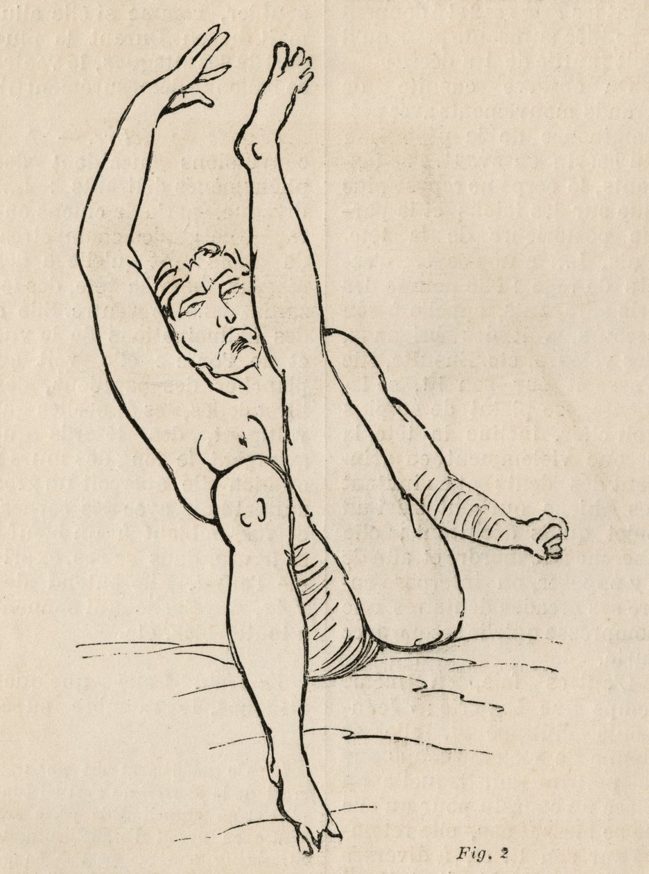 Épilepsie hystérique, attaque, contorsions, fig. 2 de 