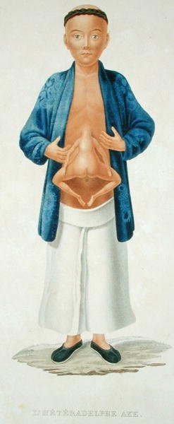 Homme chinois avec un jumeau conjoint non développé attaché à son abdomen, illustration d