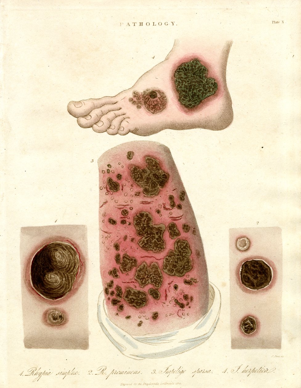 Pathologies cutanées - Pityria, impétigo et syphilis - John Pass