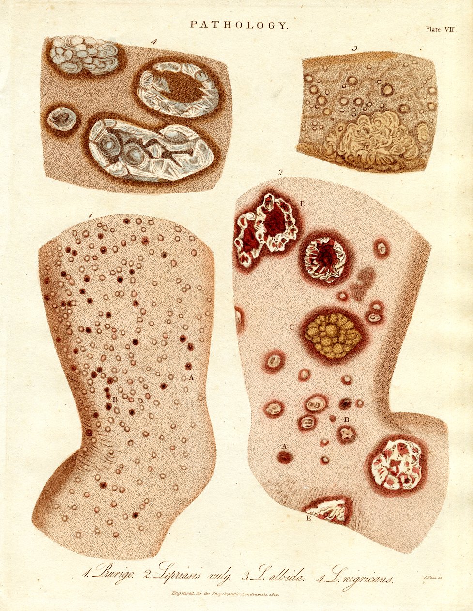 Affections cutanées pathologiques : Schurigie ; peau lépreuse ; pallada et impétigo - John Pass