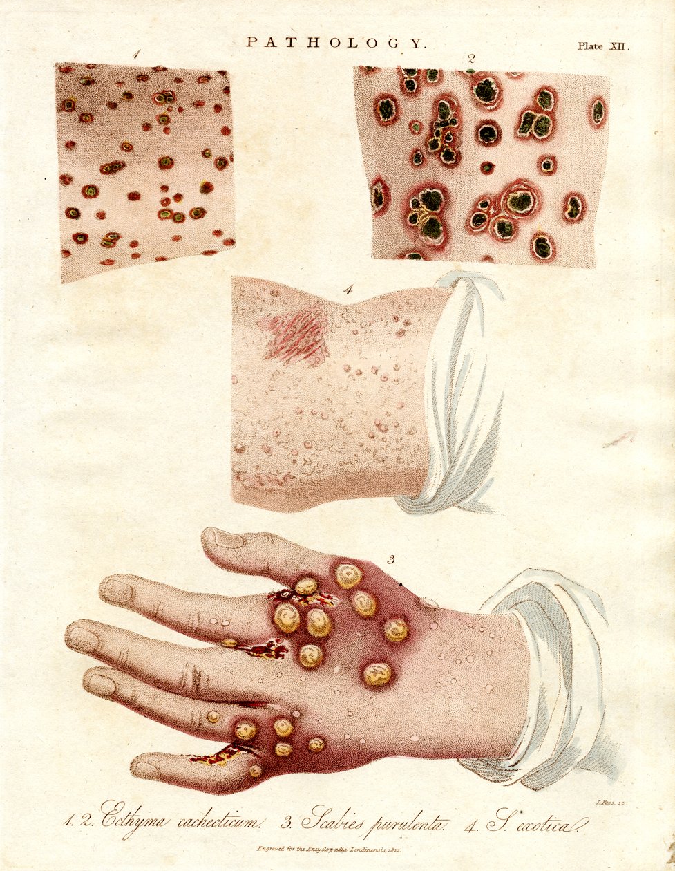 Maladies de la peau : Ecthyma, gale purulente et variole - John Pass