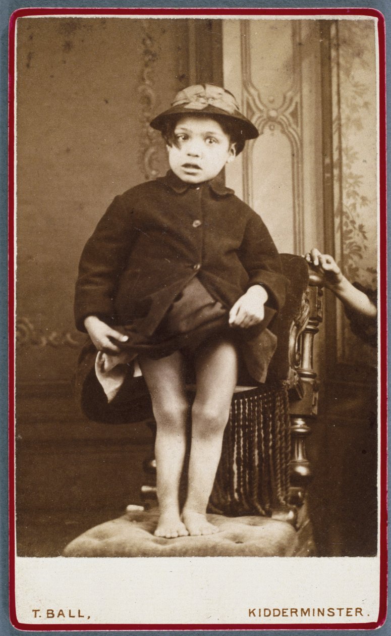 Rachitisme (jambes rachitiques) Enfant avec rachitisme - Unbekannt