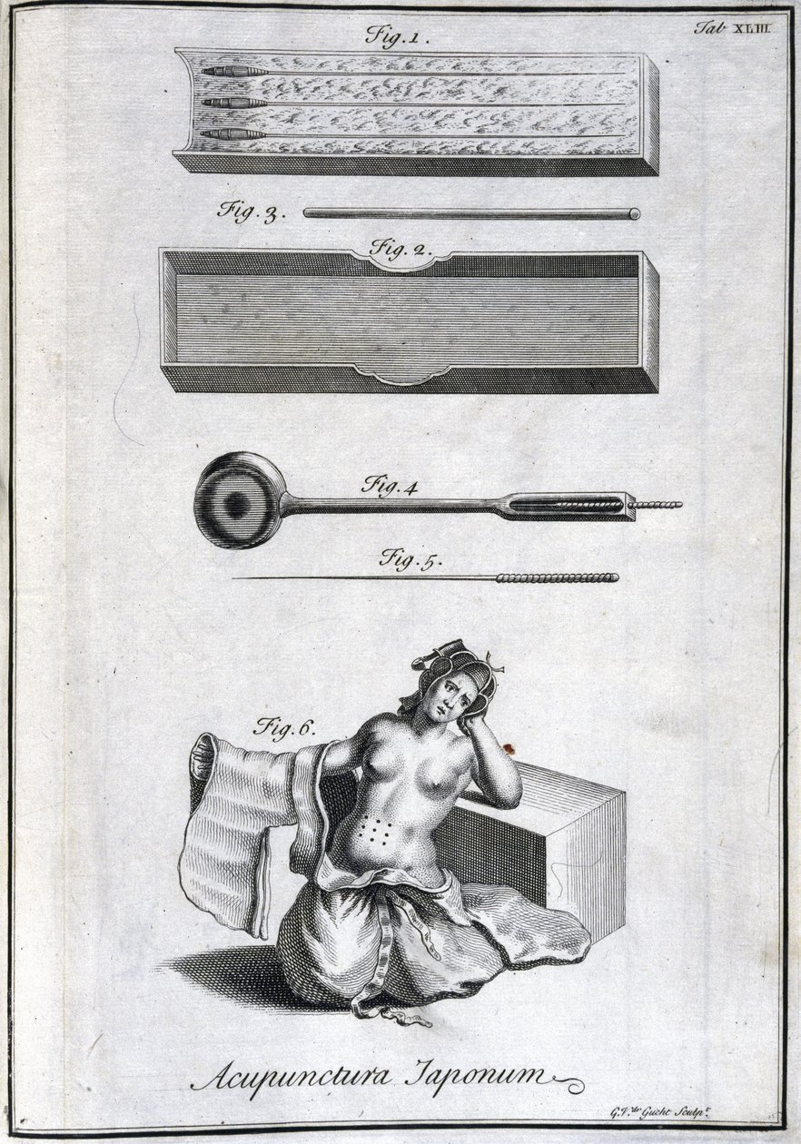 Médecine alternative : planche représentant les aiguilles d