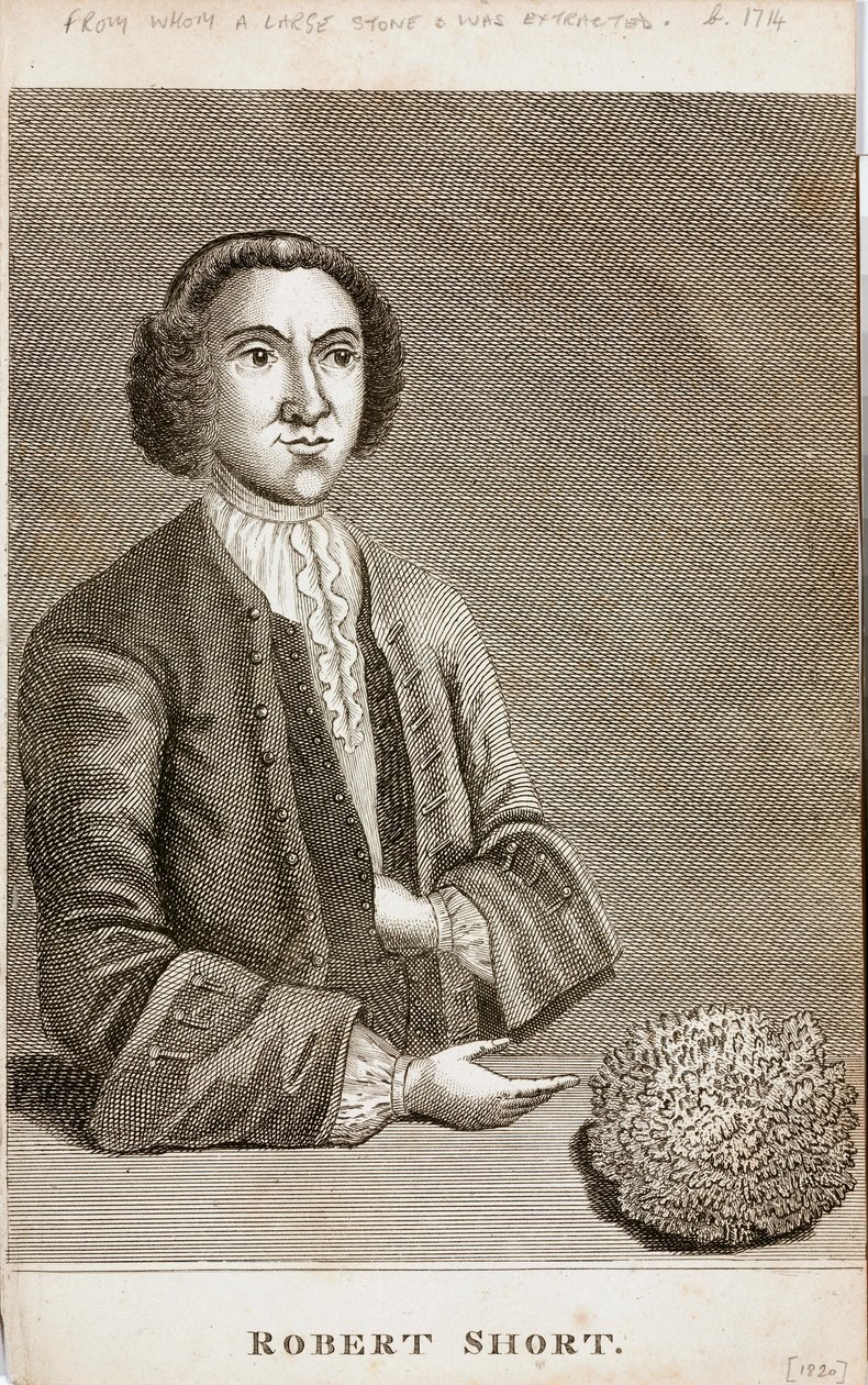 Robert Short, curiosité médicale, vers 1750 - Unbekannt