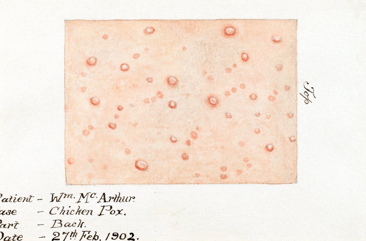 Maladies, varicelle Aquarelle de la maladie de la peau varicelle, 27 février 1902 - Unbekannt