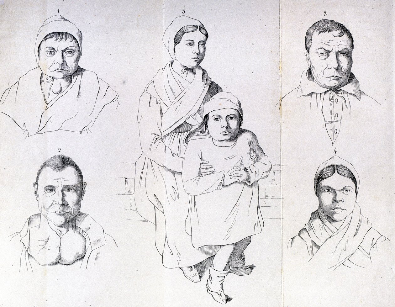 Considérations sur les causes du crétinisme endémique par Morel. - Unknown artist