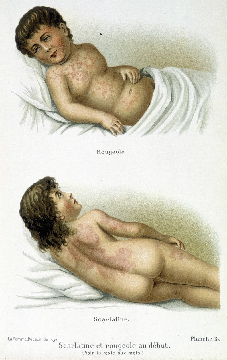 Scarlatine et rougeole - XIXe siècle - Unknown artist