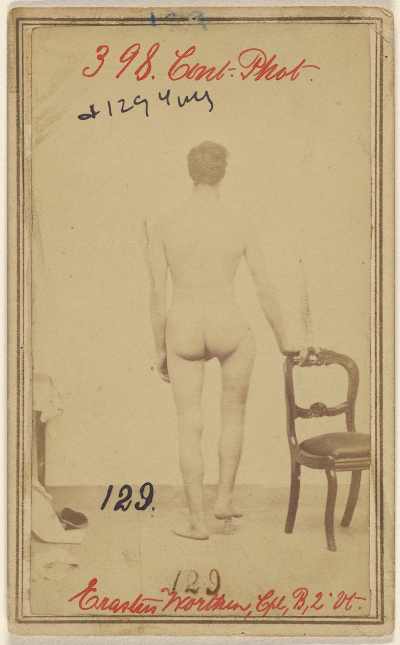 Fracture du tiers supérieur du fémur. Erastus Worthen, Corp Co. B. 2nd Vermont Vols. 25 ans - Domicile Stockbridge VT. - Unknown artist