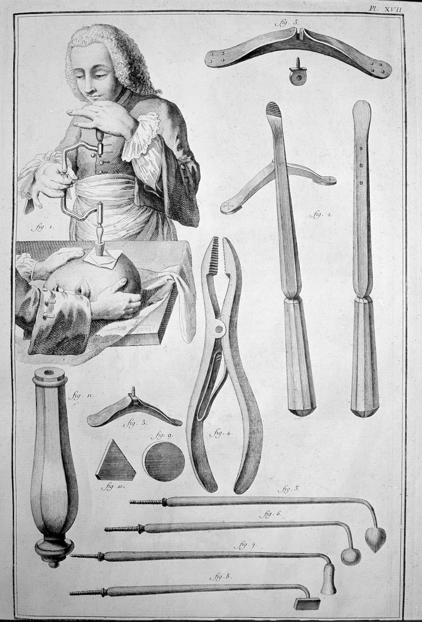 Trépanation du crâne, divers instruments (gravure) - Unknown artist