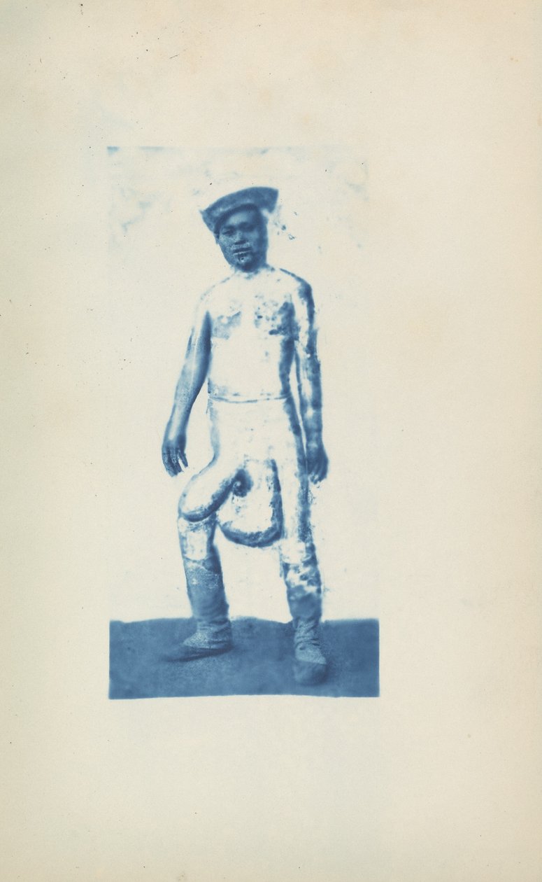 Éléphantiasis, c. 1870 (photo) - Unknown photographer