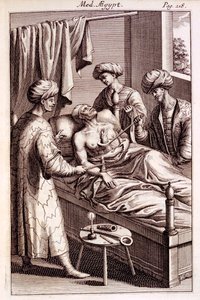 Illustration de la moxibustion de Medicina Aegyptorum par Prospero Alpinus, 1745