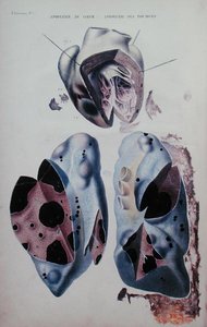 Apoplexie du cœur et des poumons, planche d