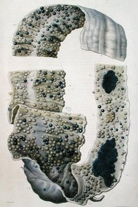 Maladies des intestins, de 