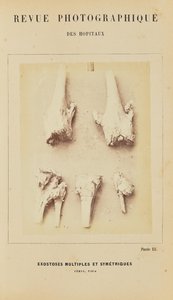 Exostoses multiples et symétriques, fémur, tibia - Arthur de Montmeja