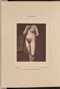 Syphilide vésiculeuse généralisée - Arthur de Montmeja