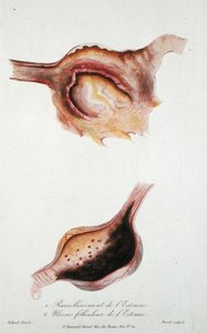Ramollissement et ulcères folliculaires de l