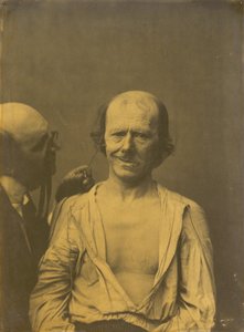 Un visage détendu à gauche, fausse joie ou rire à droite, 1854-1856, imprimé en 1862 - Duchenne de Boulogne