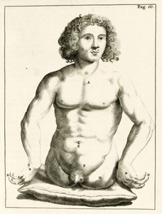 Exemple de malformations congénitales, de Exercitationes Practicae circa Medendi Methodum par Frederik Dekkers, 1694 - Dutch School