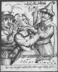 Trépanation, gravé par H. Weydmans (16ème siècle) - Dutch School