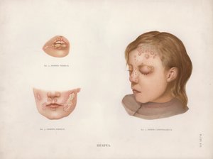 Maladies de la peau : Herpès - English School