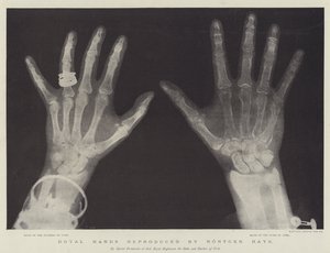 Mains royales reproduites par les rayons Röntgen (gravure)