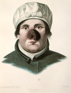 Avant une opération de greffe de peau, de 