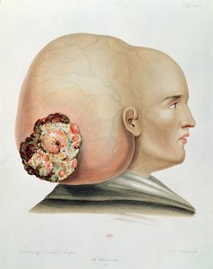 Fongus de la dure-mère, tiré de Selecta Praxis Medico-Chirurgica par Alexander Auvert, Paris, 1856