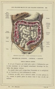 Inflammation du gros intestin, Lésions caractéristiques de la dysenterie