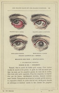 Inflammations superficielles des yeux, Ophthalmies
