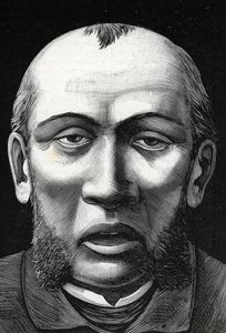 Patient avec ramollissement cérébral (gravure) 1888 - French School
