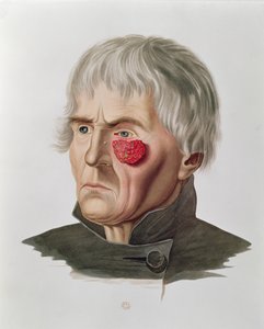 Maladie de la peau avant une opération, tiré de Selecta Praxis Medico-Chirurgica par Alexander Auvert, Paris, 1856 - French School