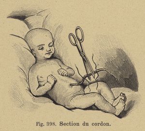 Coupe du cordon ombilical d