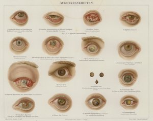 Troubles oculaires - German School