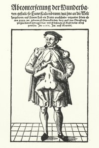 Hans Kaltenbrunn et son jumeau conjoint non développé - German School