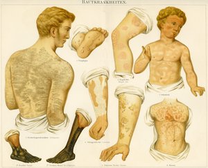 Troubles cutanés, c.1890