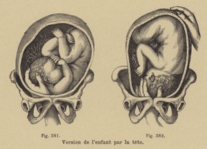 Tourner un bébé dans le ventre de sa mère pour que la tête soit orientée vers le bas avant la naissance - German School