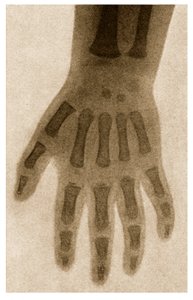 Radiographie de la main d